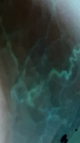 X-ray filter of my eye. I am able to see more details with this filter